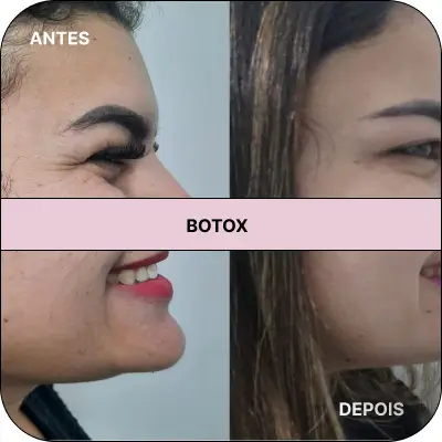 Botox